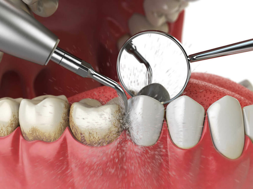 graphic of teeth being cleaned