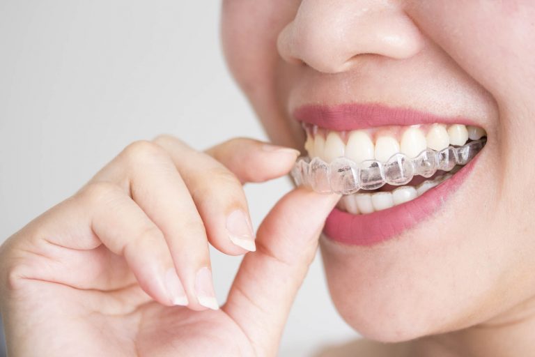 a smiling woman inserting Invisalign aligners on the top row of her teeth