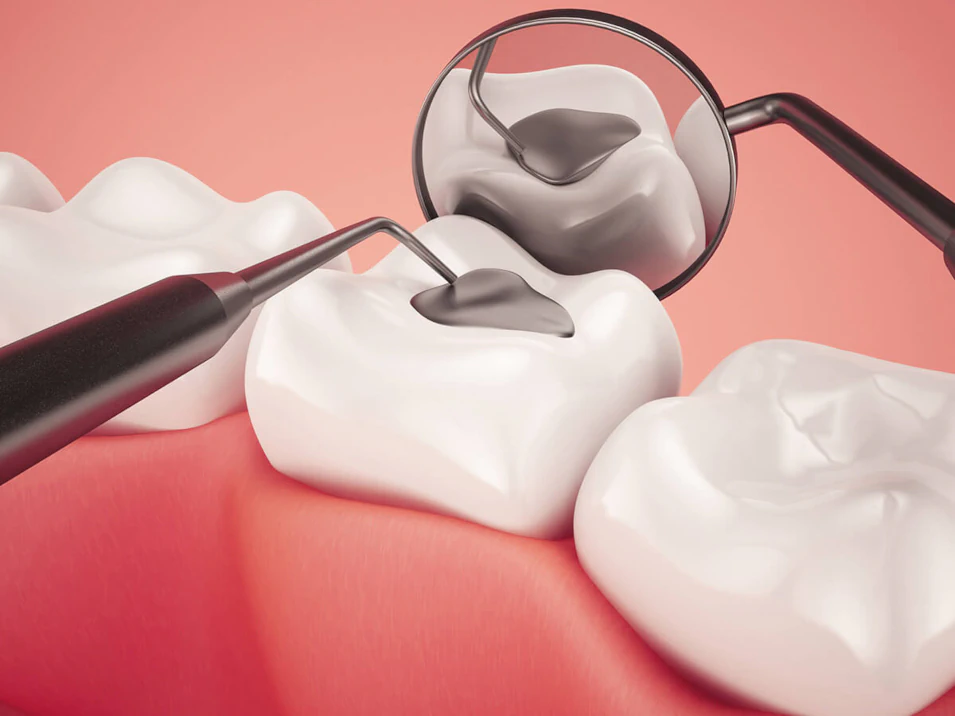 Dental fillings and sealants available at Dental Reflections Dublin in Dublin, OH