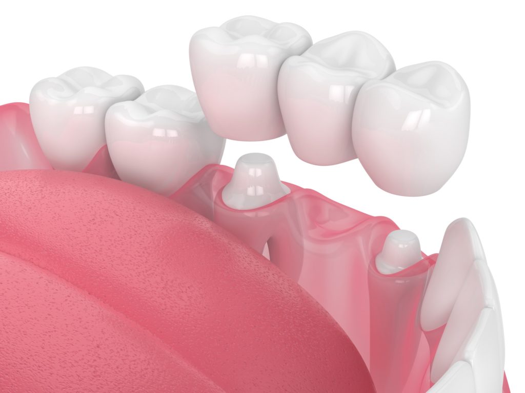 Illustration of a row of teeth with a dental crown/bridge being placed in the mouth