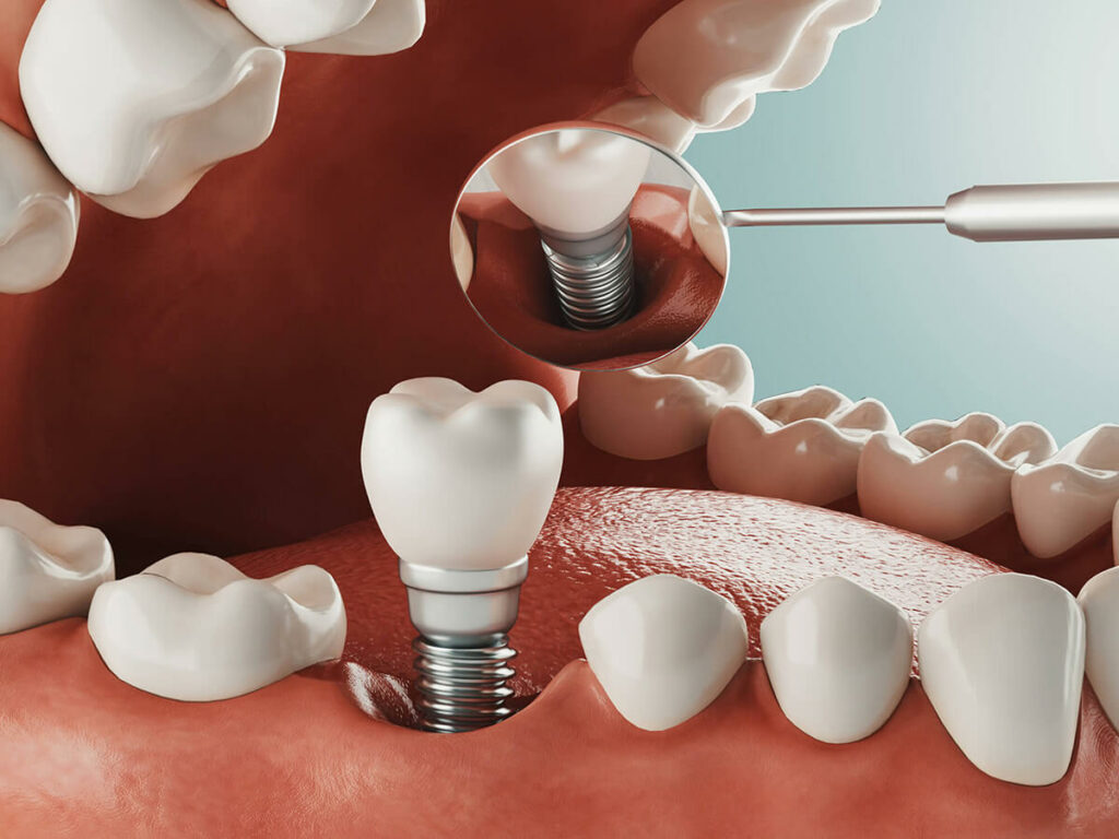 Dental Implants - Procedure and Cost - Dental Reflections Dublin
