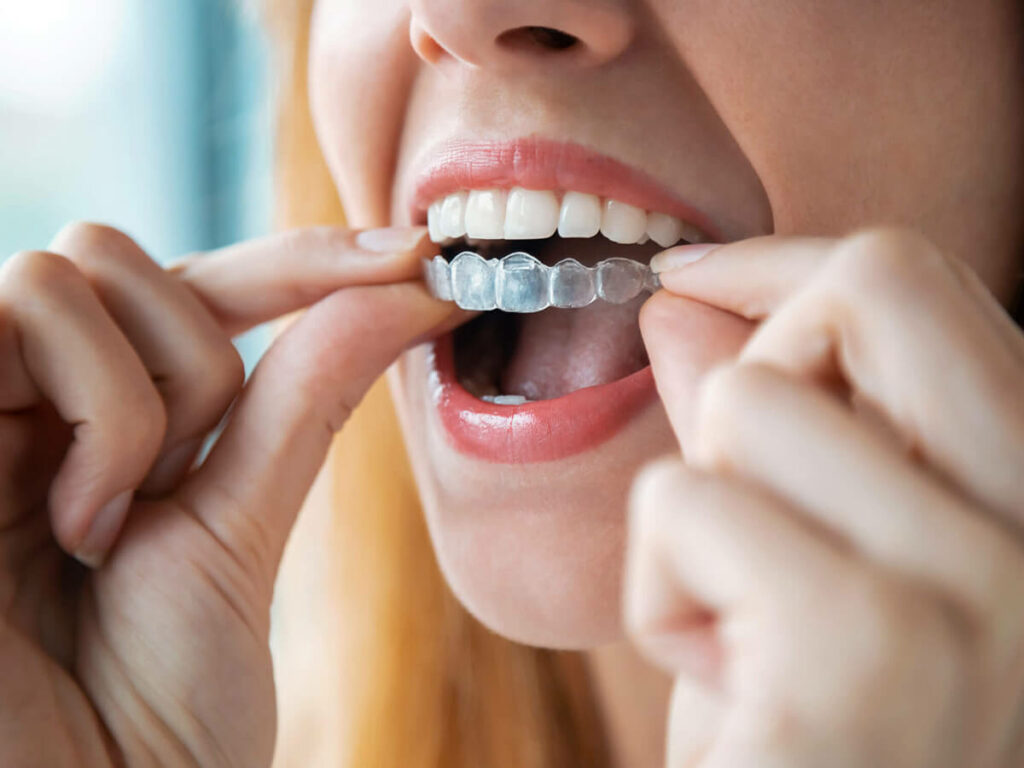 Woman putting in invisalign
