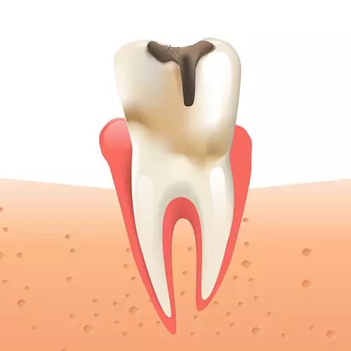 Illustration showing a tooth with visible decay at the top, indicated by a dark brown area, and red gum tissue surrounding the tooth. The image demonstrates the effects of dental caries.