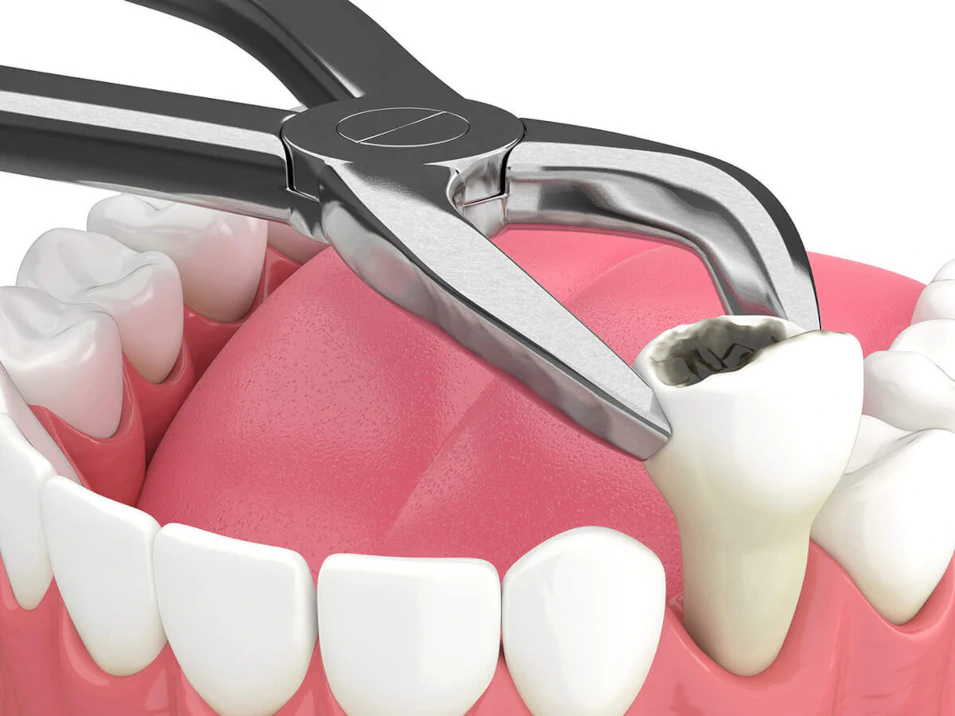 Tooth extractions available at Dental Reflections Dublin in Dublin, OH
